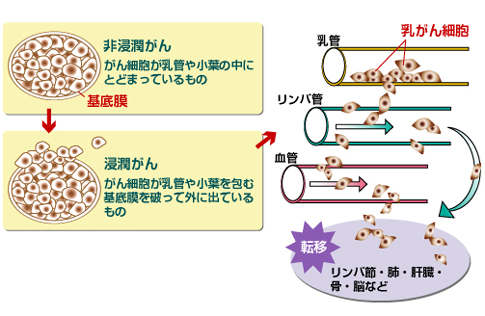 非 浸潤 性 乳 管 癌 手術 しない