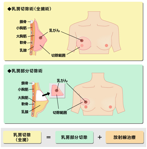 手術 乳がん 乳がん 治療：[国立がん研究センター